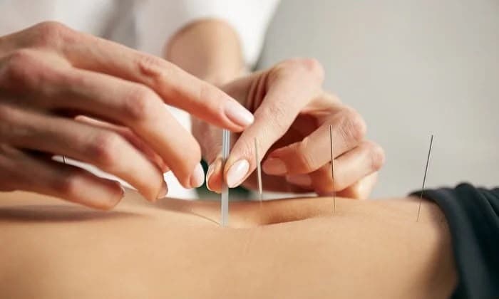 Acupuncture and Dry Needling